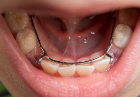 Hàm giữ khoảng - Tất cả những điều cần biết 